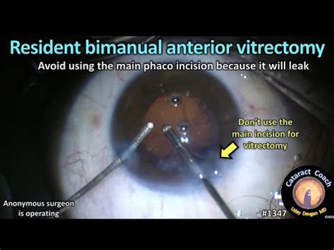 CataractCoach 1347 Resident Bimanual Anterior Vitrectomy YouTube