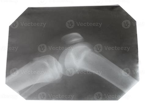 X-ray picture of human knee joint 12586508 Stock Photo at Vecteezy