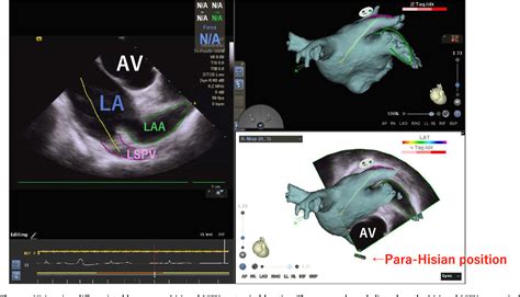 Figure From Metal Interference Alert Guided Septal Approach With