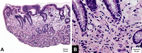 Detection Of Multiple Intramucosal Signet Ring Cell Carcinomas By White