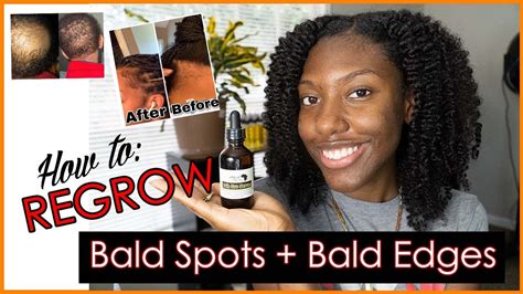 How To Regrow Your Edges Bald Spots And Thinning Hair How To Use 24k