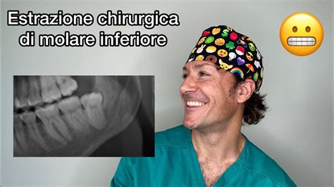 Estrazione Chirurgica Di Dente Del Giudizio Inferiore I Segreti Che