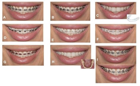 Adult Perceptions Of Different Orthodontic Appliances Ppa