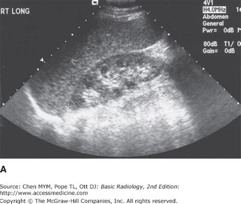 Chapter Radiology Of The Urinary Tract Radiology Key