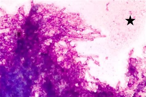 Cytology image showing aspergillus hyphae with septation and acute ...