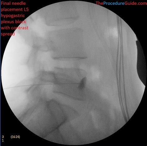 Intrathecal Access/Injection (Spinal) – Technique and Overview - The ...