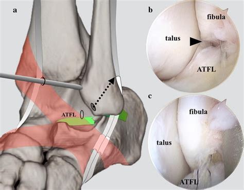 Early Recovery After Arthroscopic Repair Compared To Open Repair Of The