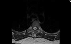 Syringomyelia MRI | Radiology article on syrinx