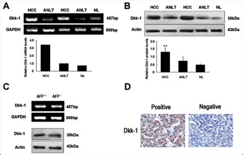 Detection Of Dkk Mrna And Protein Expression In Hcc A