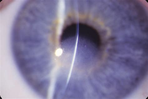 Residual Corneal Opacity After Resolution Of Pseudomonas Keratitis In A