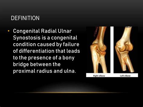 Congenital Radial Ulnar Synostosis.pptx