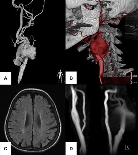 A, Angiography shows large, irregularly shaped aneurysm in the left... | Download Scientific Diagram