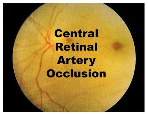 central retinal artery occlusion anatomy