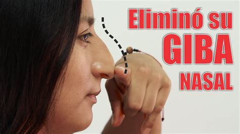 RinoplastÍa Estética Y Funcional RinoseptoplastÍa👃🏼giba Grande Y