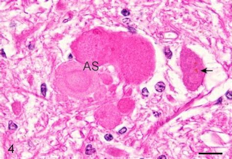 A Cluster Of Axonal Spheroids As With Several Shades Of Eosinophilia