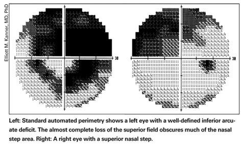 Perimetry & Glaucoma: Strategies for Success