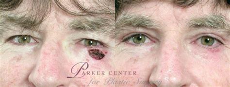 Skin Cancer Treatment Before And After Pictures Case 1067 Paramus Nj Parker Center For