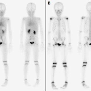 Planar Whole Body Skeletal Scan In Anterior And Posterior Projections