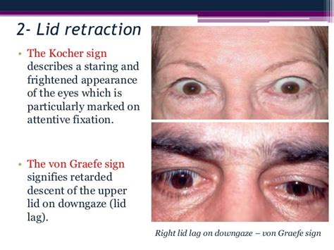 Thyroid Eye Disease