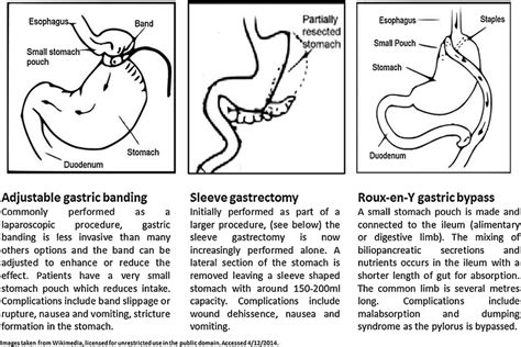 A Summary Of Common Bariatric Surgery Procedures Download Scientific