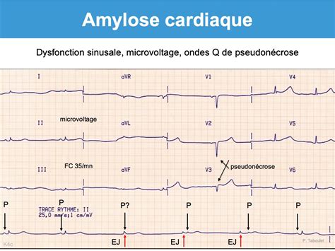 Amylose Cardiaque E Cardiogram