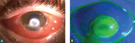 Fungal Keratitis Satellite Lesions