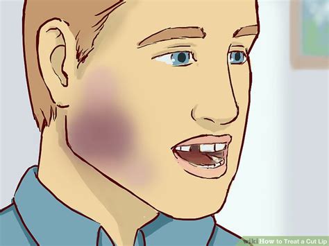 How to Treat a Cut Lip (with Pictures) - wikiHow