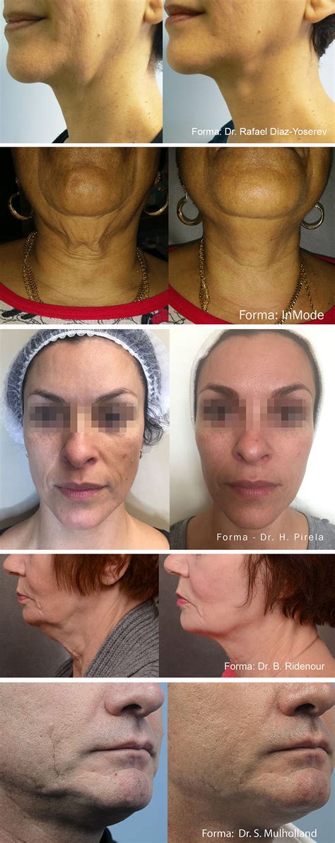 Forma Skin Tightening Laser With Morpheus8 The Hogarth Medispa