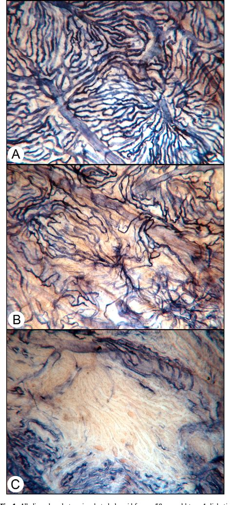 Figure 1 From Diabetic Choroidopathy Semantic Scholar