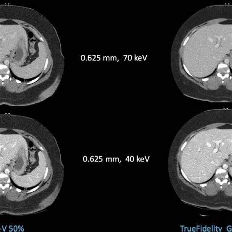 Example Dual Energy Ct Images Reconstructed With Asir V 50 And Download Scientific Diagram