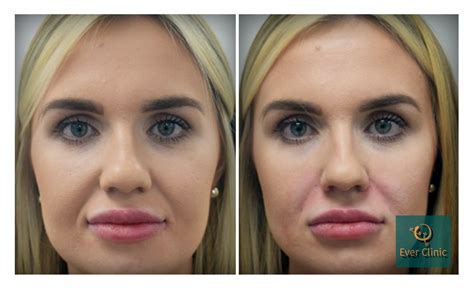 Nasolabial Fold Filler Glasgow Nose To Mouth Line Treatment