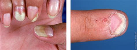 Psoriasis Nails vs. Fungus: Pictures and Differences to Look For - GoodRx