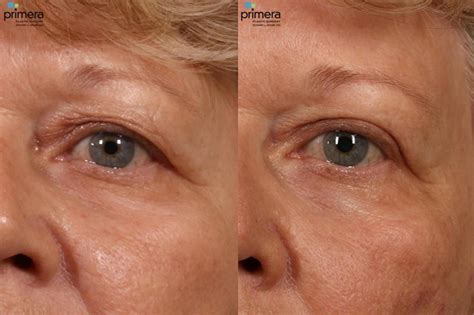 Laser Skin Resurfacing Dot Co Before And After Pictures Case