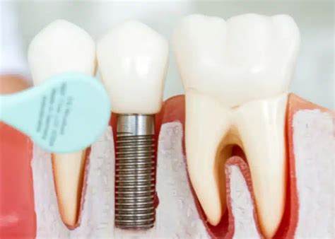 How Long Does A Dental Implant Procedure Take