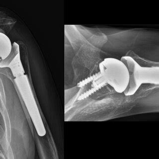 Plain Radiograph Shows Rotator Cuff Arthropathy With Superior Humeral