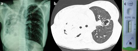 Case A Chest X Ray Showing Post Inflammatory Fibrotic Changes In The