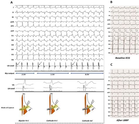 Double Transition Sign A Bipolar Pacing Showed Three Different QRS