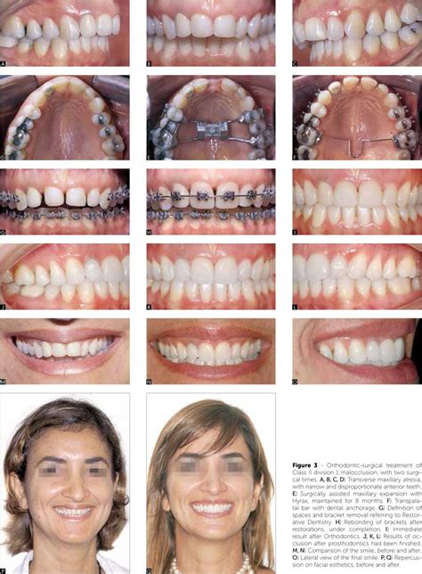 Scielo Brasil Finishing Procedures In Orthodontics Dental