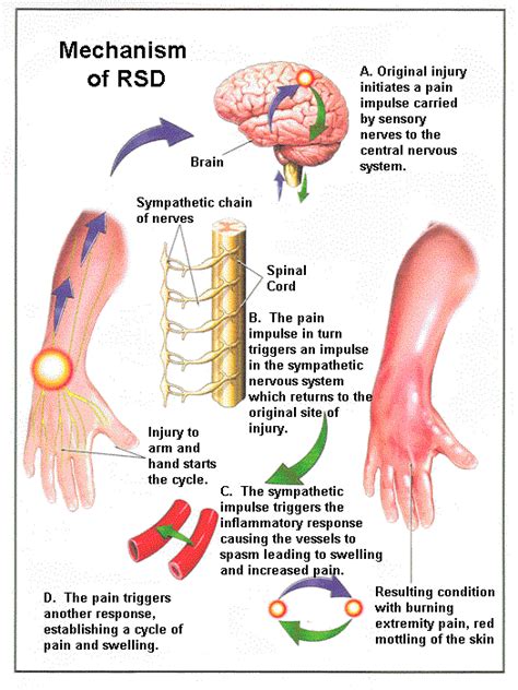 Complex Regional Pain Syndrome / Reflex Sympathetic Dystrophy | Spine ...