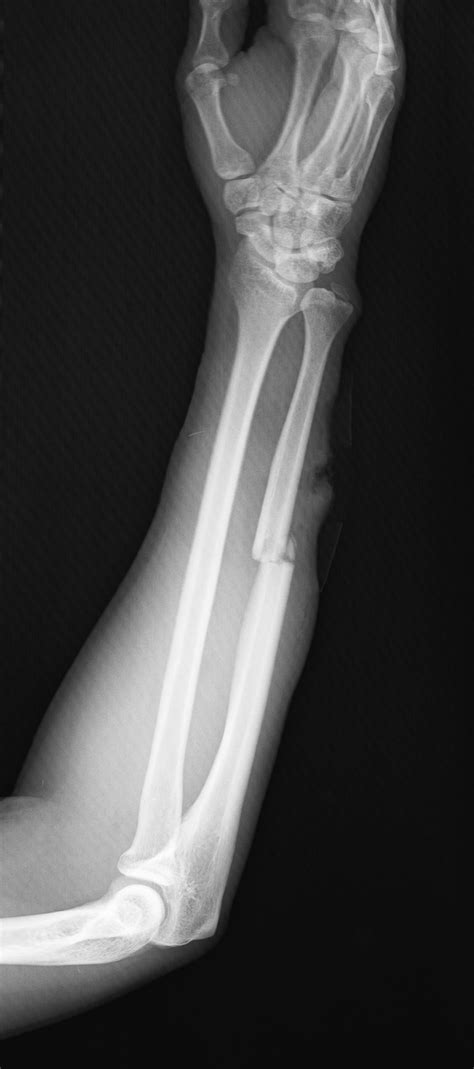 Ulna Fracture Image Radiopaedia Org