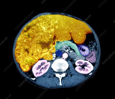 Liver Cancer Ct Scan Stock Image C0474068 Science Photo Library