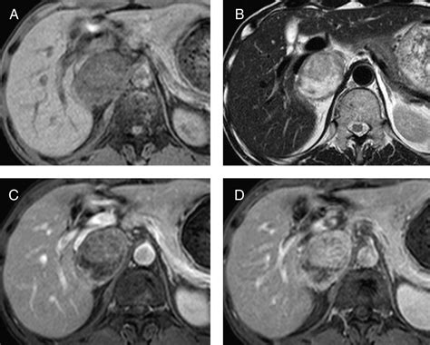 Juxta Adrenal Schwannoma Dynamic Multi Slice Ct And Mri Findings