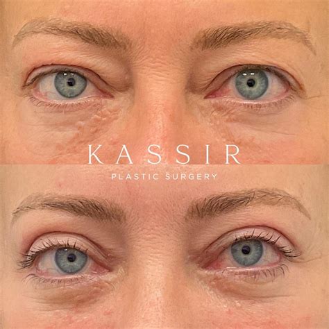 Blepharoplasty Eyelid Surgery — Kassir Plastic Surgery In Ny And Nj