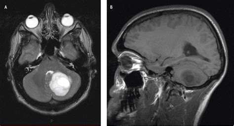 Cerebellar Syndromes A Medical Student Guide