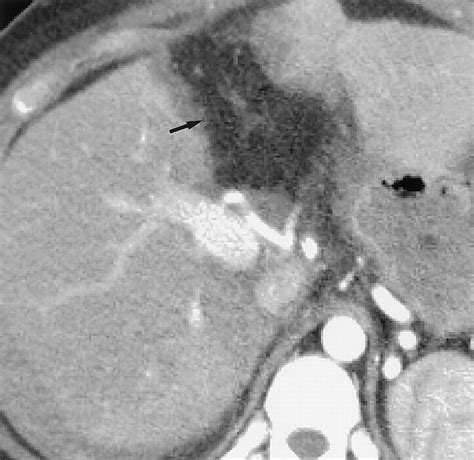 Fat Containing Lesions Of The Liver Radiologic Pathologic Correlation