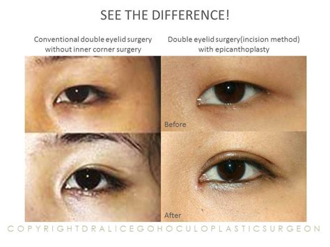 Double Eyelid With Epicanthoplasty Surgery Eyelid Surgeon Specialises