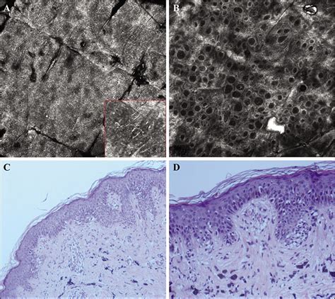 Jle European Journal Of Dermatology Melanoma On Tattoos A Case