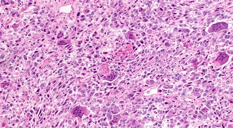 Osteoclastoma Histology