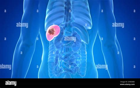 Spleen cancer, illustration Stock Photo - Alamy