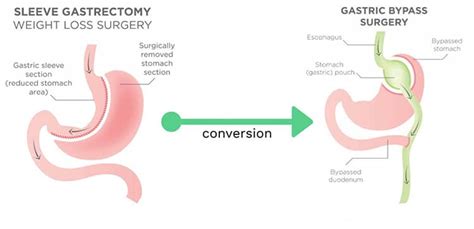 Gastric Sleeve Vs Gastric Bypass Pros Cons Cost